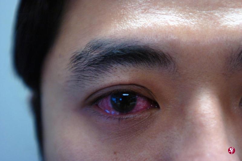 红眼病最初的症状图片图片
