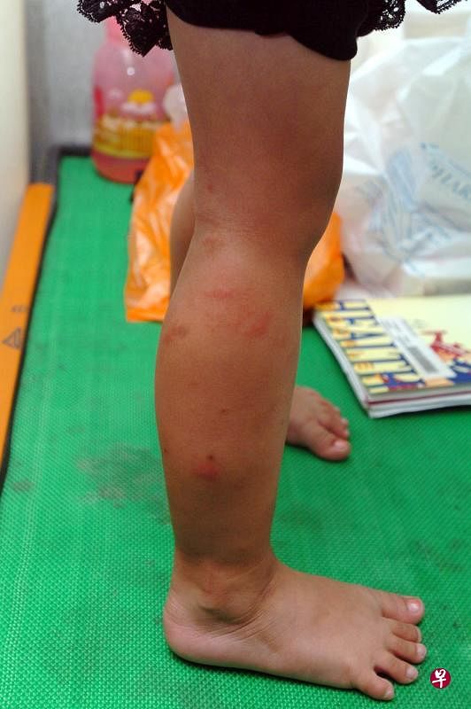 孩童被蚊子叮咬,一般无碍,但要注意是否有严重的过敏反应.(档案照)