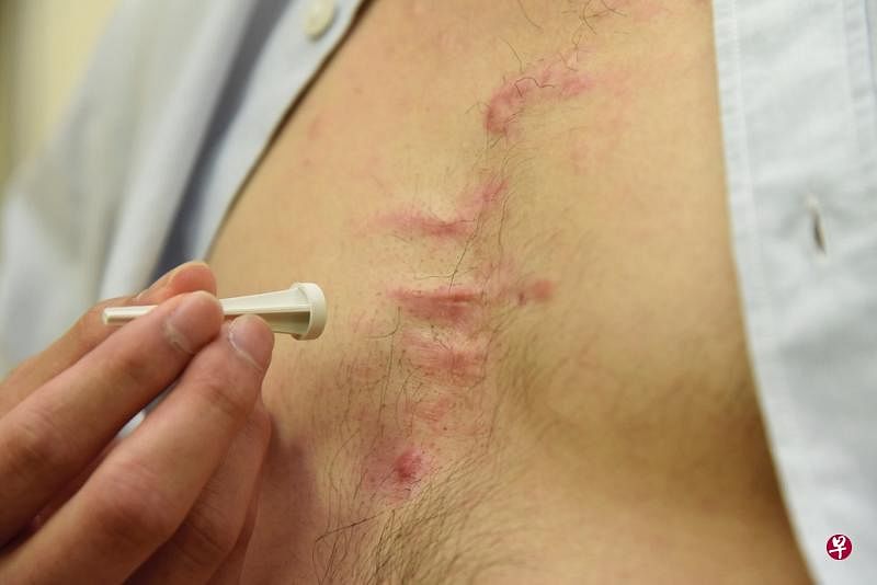 微针贴片贴在瘢痕疙瘩上,让药物以无疼痛的方式进入疤痕内缩小它